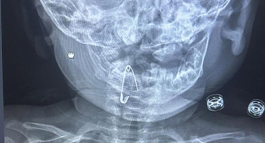 8 aylık bebeğin boğazına kaçan çengelli iğne başarılı bir operasyonla çıkartıldı