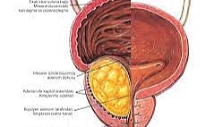 Prostat Nedir? Belirtileri Nelerdir? Nasıl Anlaşılır?