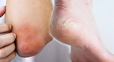 Vitamin Eksikliği Nedir? Vitamin Eksikliğinin Belirtileri Nelerdir? Neden Olur?