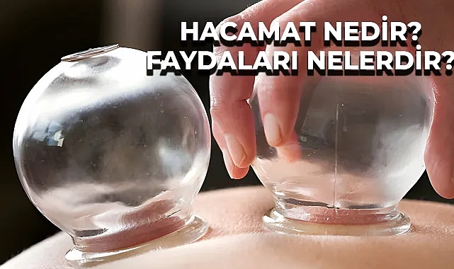 Hacamat Nedir? Yaptıranlar Dikkat Etsin! İşlem Sonrasında Sakın Bunları Yemeyin! Dikkat Edilmesi Gerekenler...