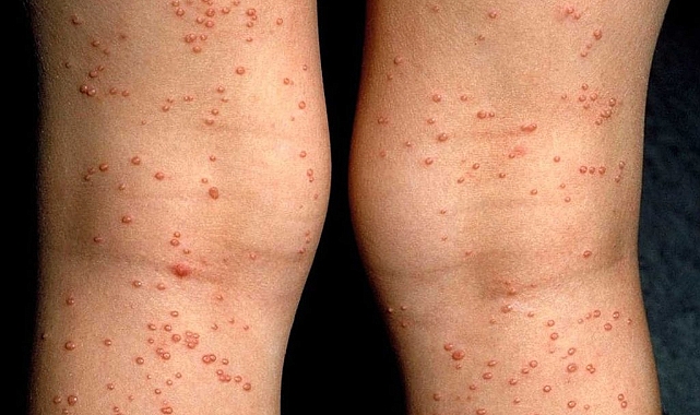 HIV/AIDS Nedir? AIDS Belirtileri Nelerdir?