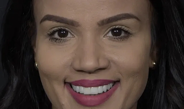 Hollywood Smile Nedir? Hollywood Gülüşü Nedir?