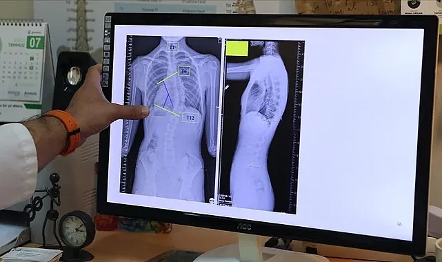 Skolyoz neden olur? Skolyoz olmaması için ne yapmalı?