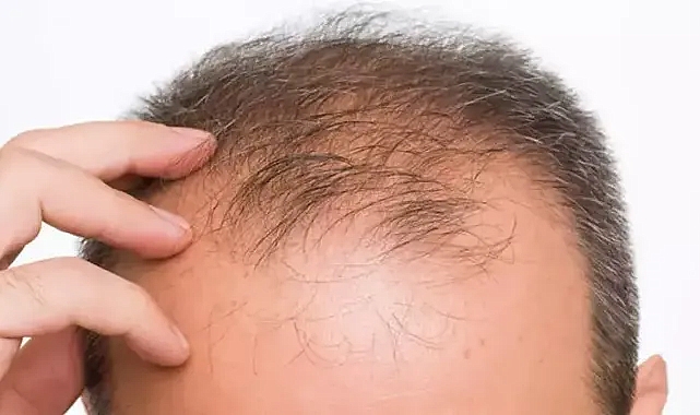 Saç Dökülmesine Ne İyi Gelir? Saç Dökülmesi Nasıl Geçer?