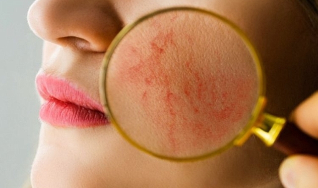 Lupus hastalığı nedir? Lupus hastalığı neden olur? Lupus hastalığının belirtileri nelerdir?