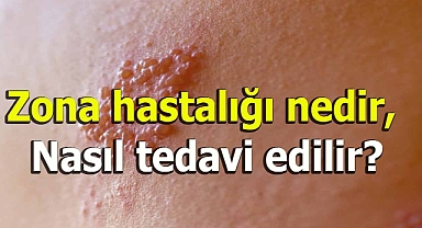 Zona hastalığı nedir, Nasıl tedavi edilir?