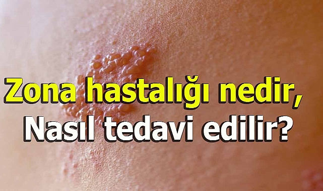 Zona hastalığı nedir, Nasıl tedavi edilir?