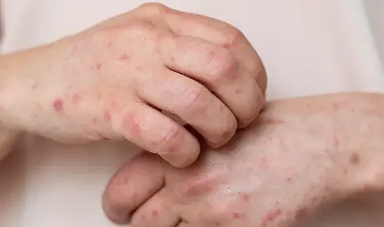 Maymun Çiçeği Virüsü Nedir? Belirtileri ve Tedavisi