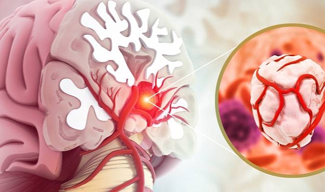 Tümör Nedir? İyi ve Kötü Huylu Tümörler Nelerdir?
