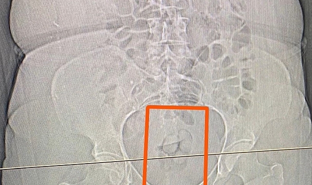 Midesinden 21,39 gram uyuşturucu çıktı