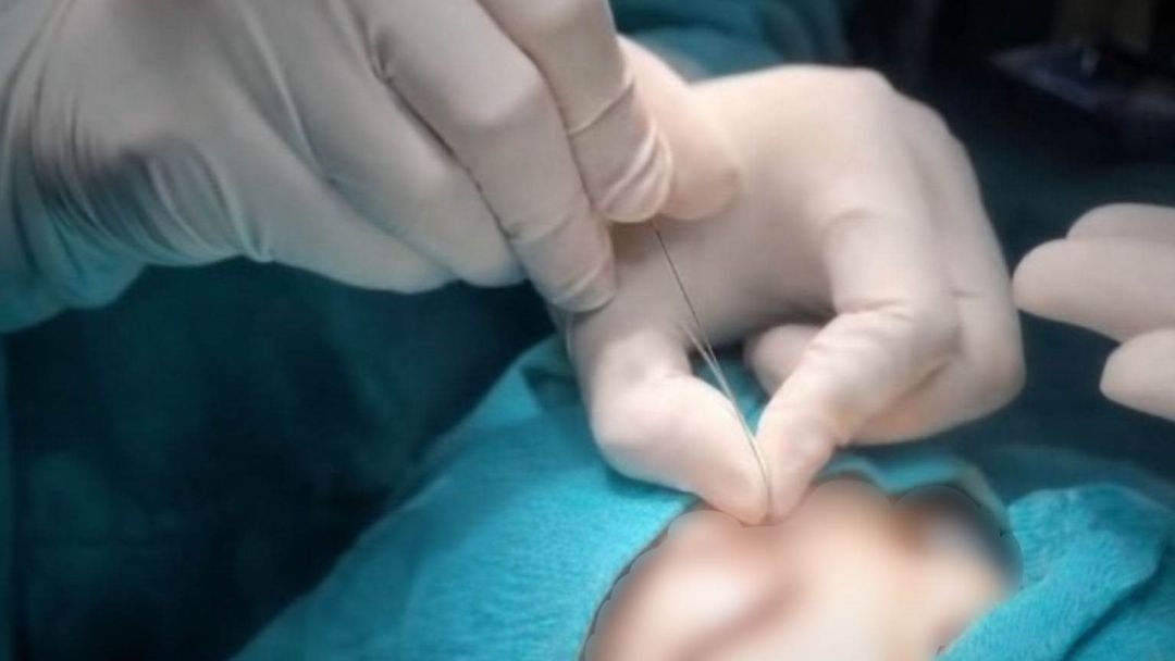 Çukurca’da gözyaşı kanalı ameliyatları yapılmaya başlandı