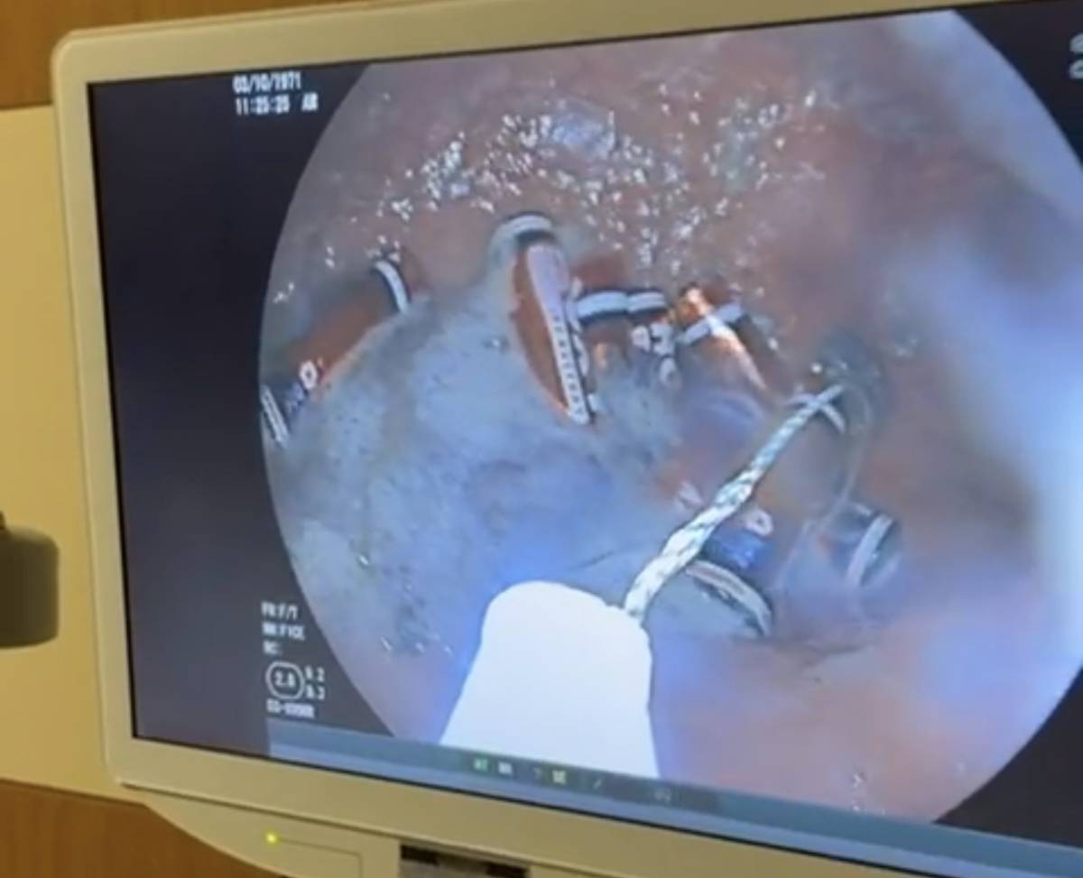 Ağrı’da mideden çıkanlar görenleri şaşkına çevirdi